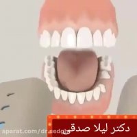 کاندید روکش دندان چه کسانی هستند ؟