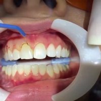 اصلاح طرح لبخند-دکترمجیدقیاسی دندانپزشک زیبایی درمشهد