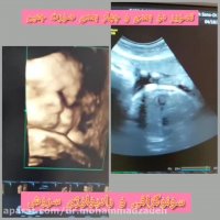 تصویر دو بعدی و چهار بعدی صورت جنین