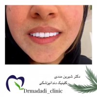 ونیر کامپوزیت