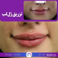 تزریق ژل لب در کلینیک ارکیده