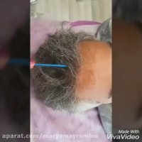 اسکالپ تخصصی روشی نوین برای رفع کم پشتی موهای سر