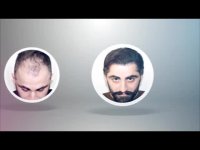 فیلم از نتایج کاشت مو