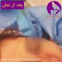 فیلم قبل و بعد از جراحی زیبایی بینی