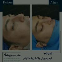 عمل بینی مردانه توسط دکتر بصام