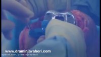 عمل جراحی تعویض مفصل زانو توسط دکتر جواهری