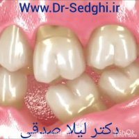 بی توجهی به دندان افتاده