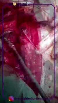 فیلم تعویض مفصل ران در بیمار پنجاه ساله