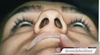 عمل بینی با نوک پهن و انحراف | دکتر ابراهیمی