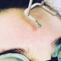 رفع چین و چروک و جوانسازی پوست صورت با دستگاه یولیزر ساخت کمپانی کوانتا ایتالیا