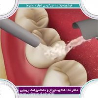 نحوه ی پر كردن شیار دندان ها | دکتر ندا هادی جراح و دندانپزشک زیبایی