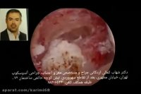 جراحی هیدروسفالی ناشی از تومور داخل بطنی (دکتر کمالی)