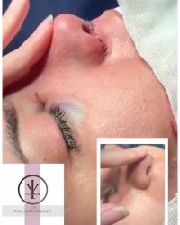 فیلم واقعی جراحی بینی گوشتی