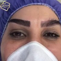 کاشت ابرو کلینیک تخصصی رنسانس