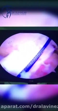 عمل بازسازی رباط صلیبی قدامی با الوگرافت