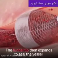 خارج کردن لخته خون از عروق