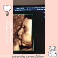 فیلم سونوگرافی چهاربعدی پسر (37 هفتگی)