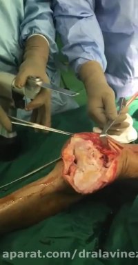 عمل تعویض مفصل زانو