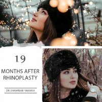 نتیجه جراحی بینی بعد از 19 ماه توسط جراح بینی تهران دکتر شهریار یحیوی