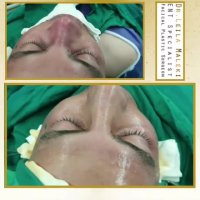 جراحی بینی آقایان