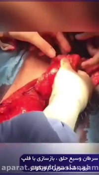 سرطان وسیع حلق، بازسازی با فلپ تیوب شده سوپراکلاوی