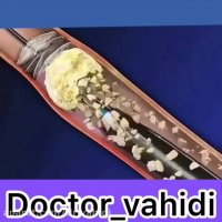 انیمیشن جراحی سنگ حالب