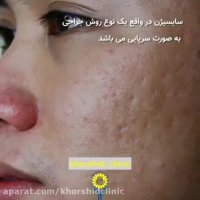 سابسیژن چیست؟