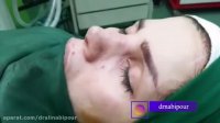 فیلم بلافاصله بعد از جراحی بینی