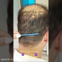 میکرواسکالپ محل اسکار بخیه