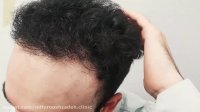 رضایت مراجع کاشت مو در کلینیک دکتر نیلفروش زاده