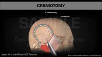 کرانیوتومی