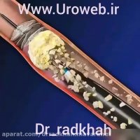 درمان سنگ حالب