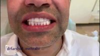 فیلم لمینت دندان | دکتر فرشید محرابی