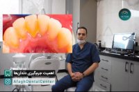 جرمگیری دندان