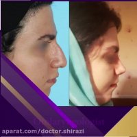 فیلم نمونه قبل و بعد عمل بینی