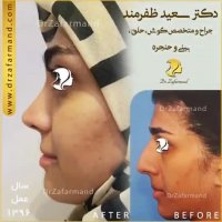 نمونه کار جراحی بینی دکتر سعید ظفرمند