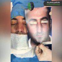 جراحی بینی گوشتی