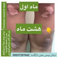 درمان صد در صد پیسی