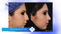 فیلم نتیجه جراحی بینی