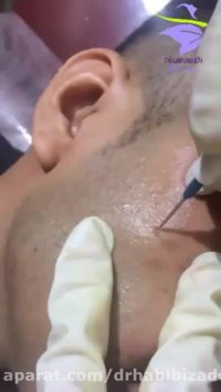 برداشتن خال ریز صورت با RF