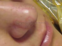 کوچک کردن بینی با پلاسما