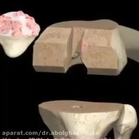 فیلم تعویض مفصل زانو