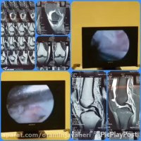 عملیه تمزق الرباط الصلیبی