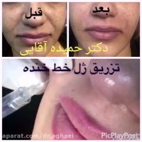 تزریق ژل در خط خنده