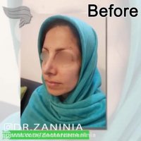 کاشت ابرو به روش جدید