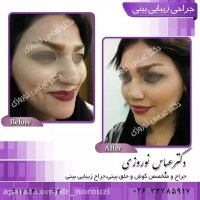 نمونه کار جراحی زیبایی بینی