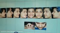 جراحی بینی گوشتی قوزدار توسط دکتر امید ابراهیمی بهترین جراح بینی