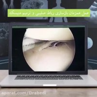 فیلم عمل واقعی همزمان بازسازی رباط صلیبی و ترمیم منیسک در شیراز