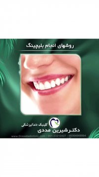 روش های بلیچینگ دندان