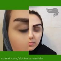 نحوه کاشت ابرو